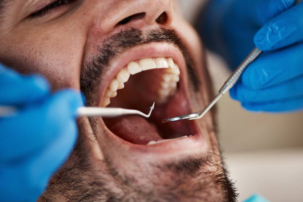 Best Emergency Dental Extractions in Elwood, IN
