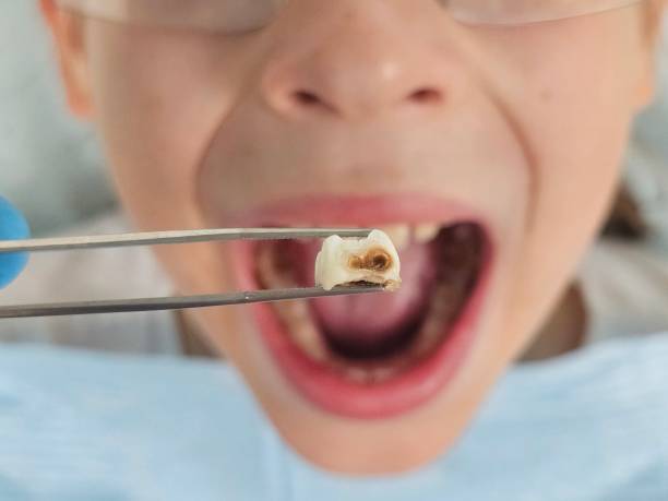 Best Emergency Dentist for Knocked-Out Tooth in Elwood, IN
